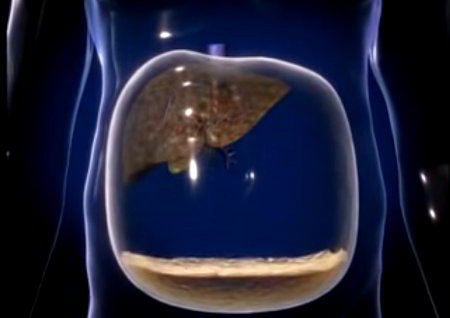 Transparent abdomen showing peritoneal cavity filling with fluid