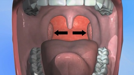 The tonsils, located on both sides at the back of the mouth