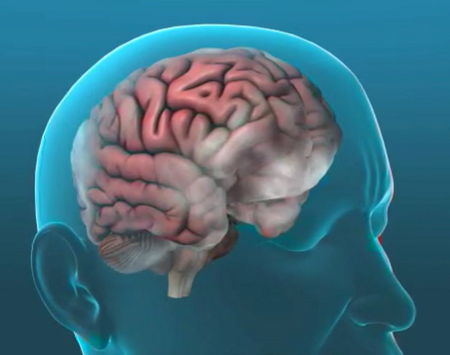 Transparent 3D head model showing a foggy brain inside