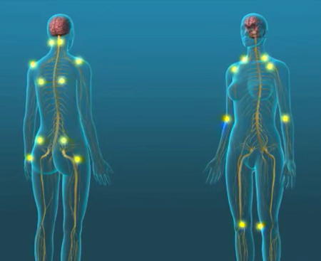 Back and front images of a woman with 18 tender point locations