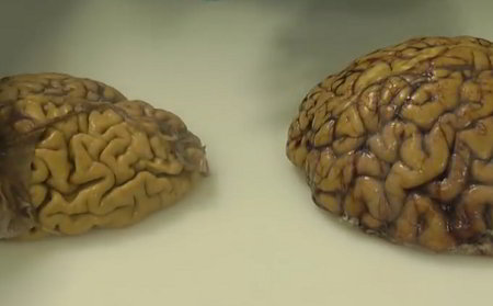 Comparing a brain with Alzheimer's disease to a normal brain