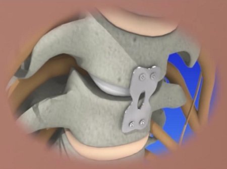 Anterior cervical discectomy and fusion (ACDF) surgery