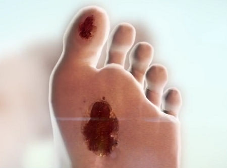 Two arterial ulcers, located on the bottom of a foot and toe
