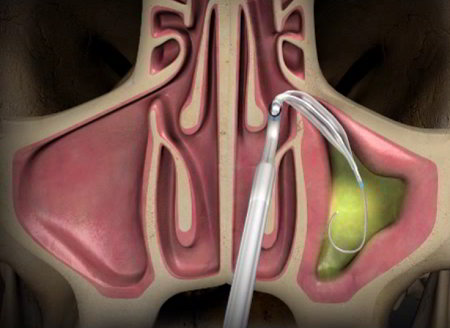 Balloon catheter inflating inside a blocked sinus passage