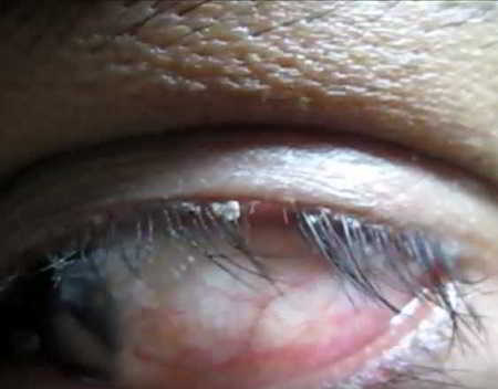 Blepharitis eyelash flakes