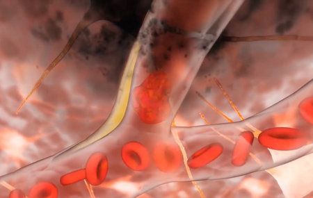 Blood flow blocked by blood clot causing brain tissue death