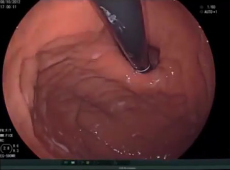 Inside of the stomach with endoscope entering through the LES