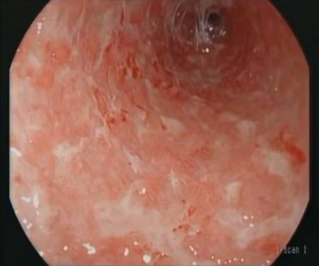 Endoscopy image showing signs of ulcerative colitis in the colon
