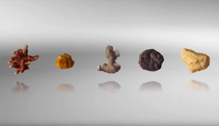 The 5 different types of kidney stone