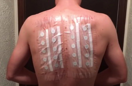Man's back with food patches stuck on with tape for allergy test