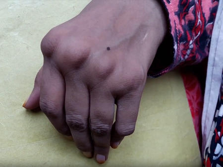 Woman's left hand with swollen knuckles and malaligned fingers