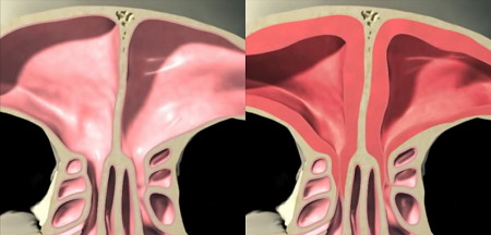 Cross-section comparison of a healthy and blocked sinus cavity