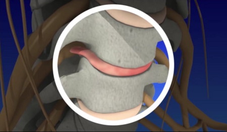 Herniated cervical disk highlighted between two vertebrae