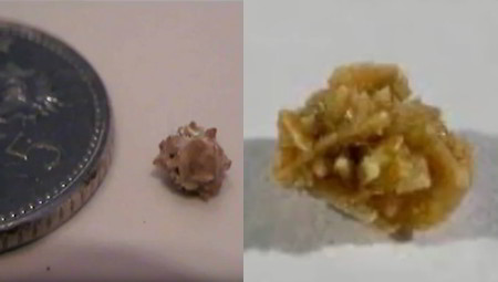 Close-up of kidney stones shown next to coin for sense of scale