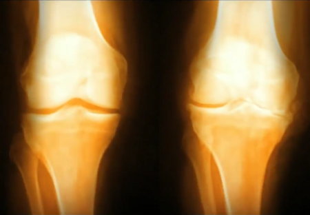 Side-by-side X-rays of healthy and osteoarthritic knee joints