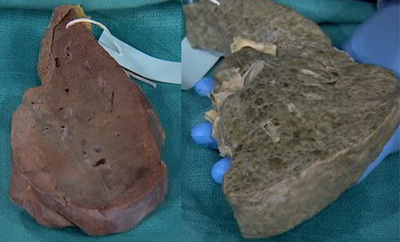 Healthy liver (grayish red) compared to cirrhotic liver (gray)