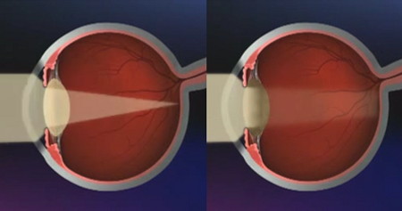 A normal eye lens and an eye lens with cataract focusing light