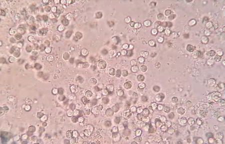 Microscopic image of urine: pus cells, red blood cells, bacteria