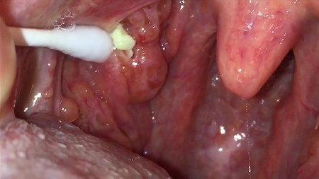 Removing a tonsil stone from the right tonsil using a Q-tip
