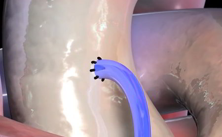 One end of a grafted vein (blue) sutured to the aorta (white)